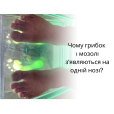 Чому грибок і мозолі зʼявляються на одній нозі? 