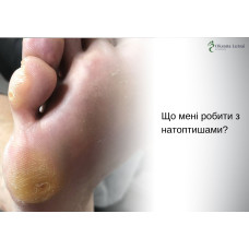 Що мені робити з натоптишами?