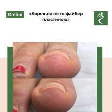 Онлайн курс «Корекція нігтя файбер пластиною» 