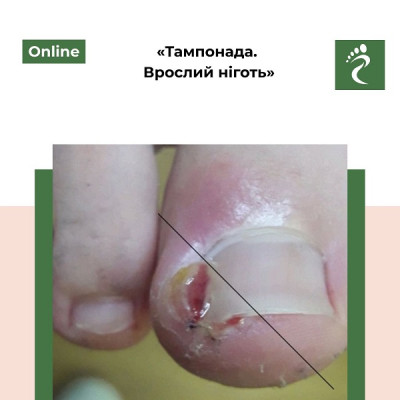 Онлайн курс «Тампонада. Врослий ніготь" 